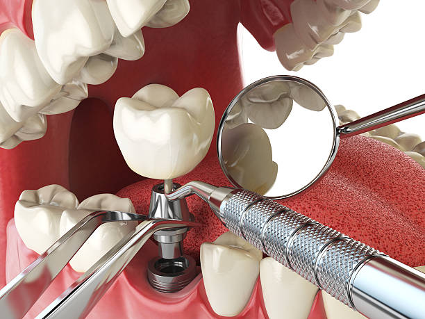Best Emergency Treatment for Dental Infections or Abscesses in Alhambra, CA